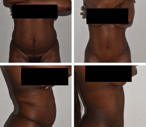 Four side-by-side photos display a woman's midsection and chest from different angles, partially obscured by black boxes, showcasing the before and after results of an abdominoplasty.