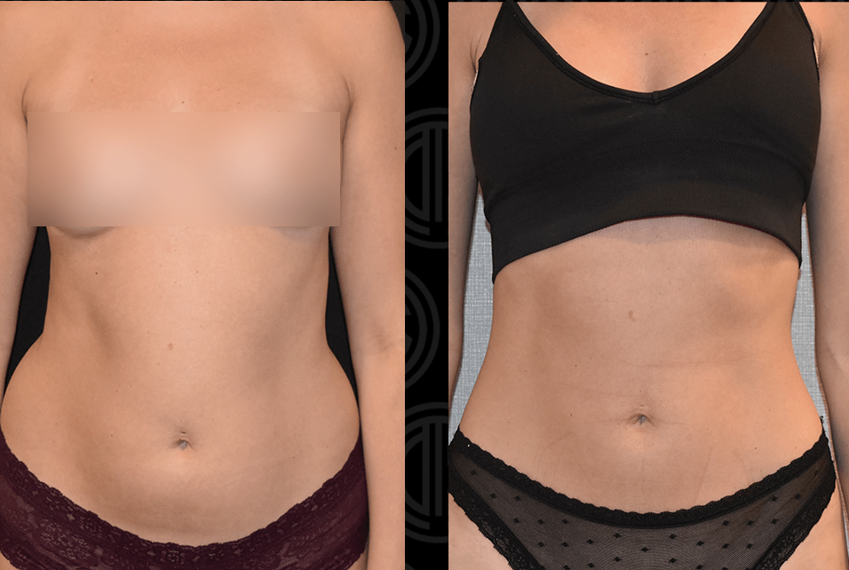 Abdomen Lipo Before and After Photo Gallery, Page 2 of 6