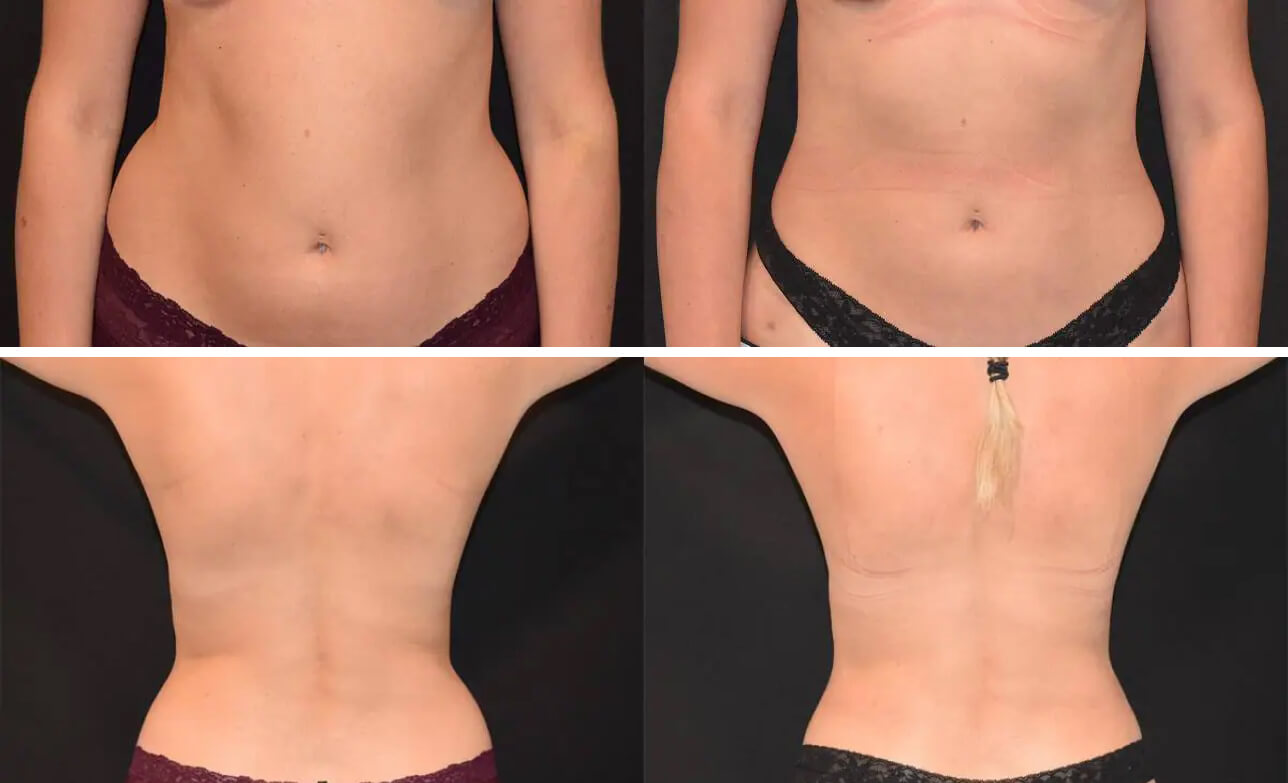 34 female 5 months after Lipo 360