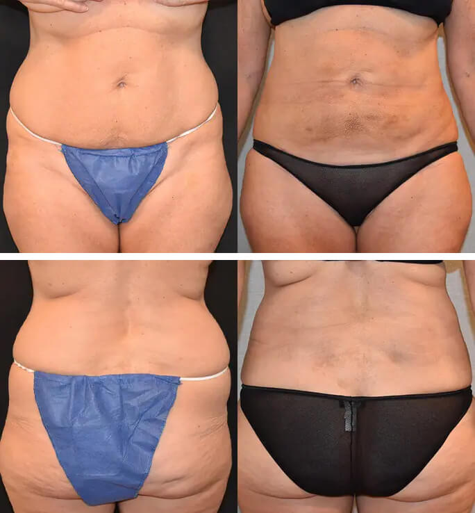 Tummy Tuck (Abdominoplasty) Plus Size Before and After Photos Beverly Hills  - Plastic Surgery Gallery Los Angeles, CA - Dr. Sean Younai