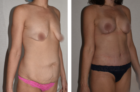 Before and after comparison photos of a woman showcasing the stunning results of her Mommy Makeover, which includes breast augmentation and tummy tuck surgery. The 'before' image is on the left, while the 'after' image is on the right.