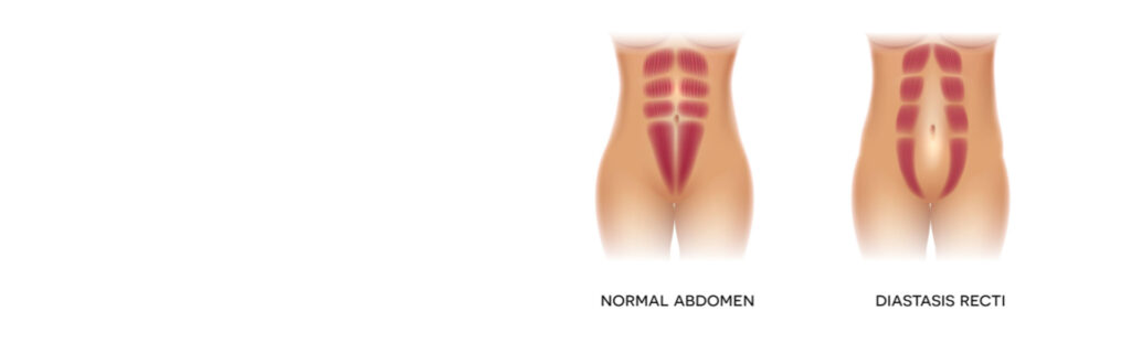 Diastasis Recti: How To Know If You Have It – Mommy Matters