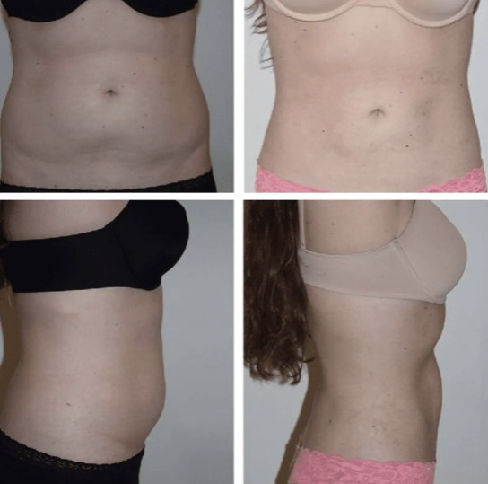 360 Lipo Without Tummy Tuck: Things You Need to Know - Salameh Plastic  Surgery Center