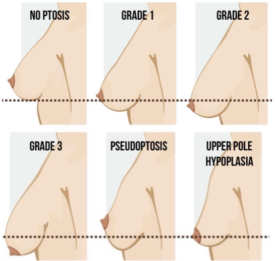 A diagram displaying various types of breasts, relevant for those considering a Mommy Makeover.