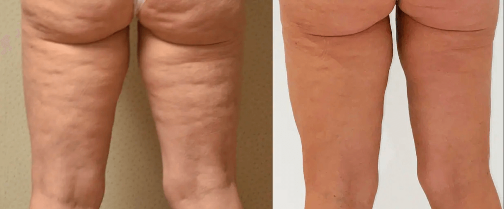 Dallas Mons Pubis Liposuction  AirSculpt® Pubic Fat Removal