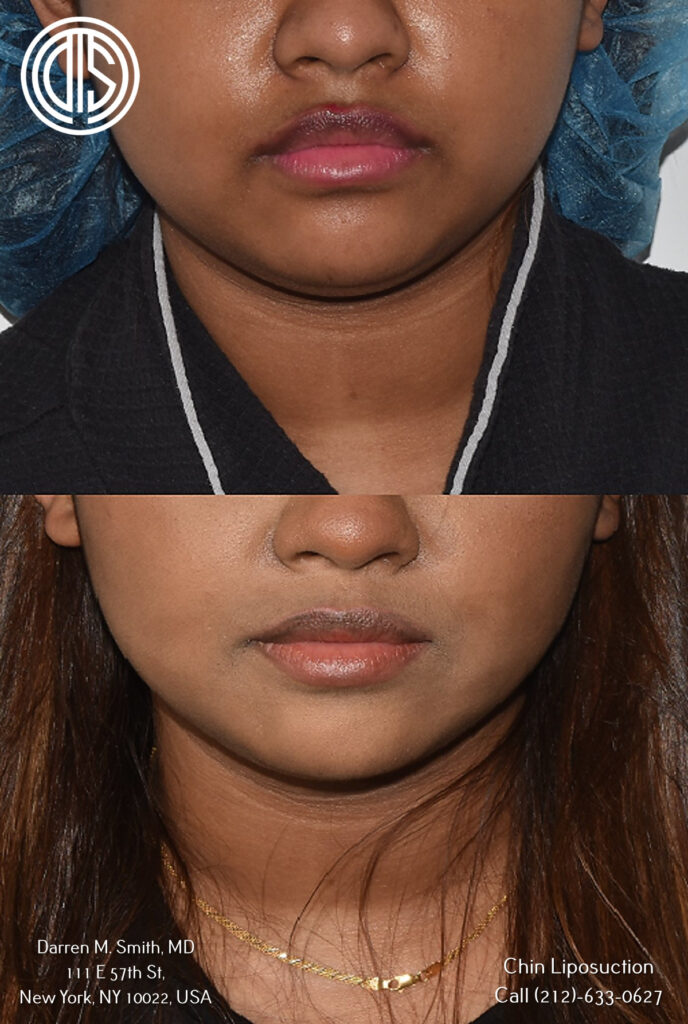 Chin Lipo - Stretching, Compression Garment, and Swelling Questions :  r/PlasticSurgery
