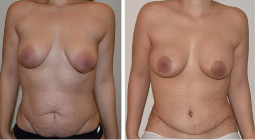 A woman's breast before and after a Mommy Makeover surgery.