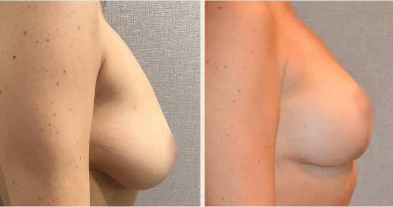 A woman's breasts before and after breast augmentation as part of a mommy makeover.
