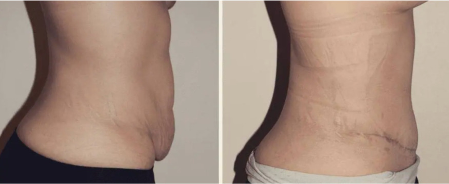Mommy makeover with tummy tuck before and after.
