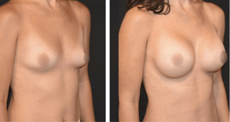 A woman's breasts before and after undergoing a mommy makeover with breast augmentation.