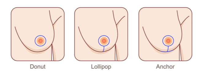 A diagram illustrating the stages of breast cancer and its progression.