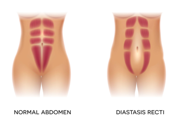 A diagram showing the difference between a normal abdomen and a rectum, with emphasis on the Mommy Makeover procedure.