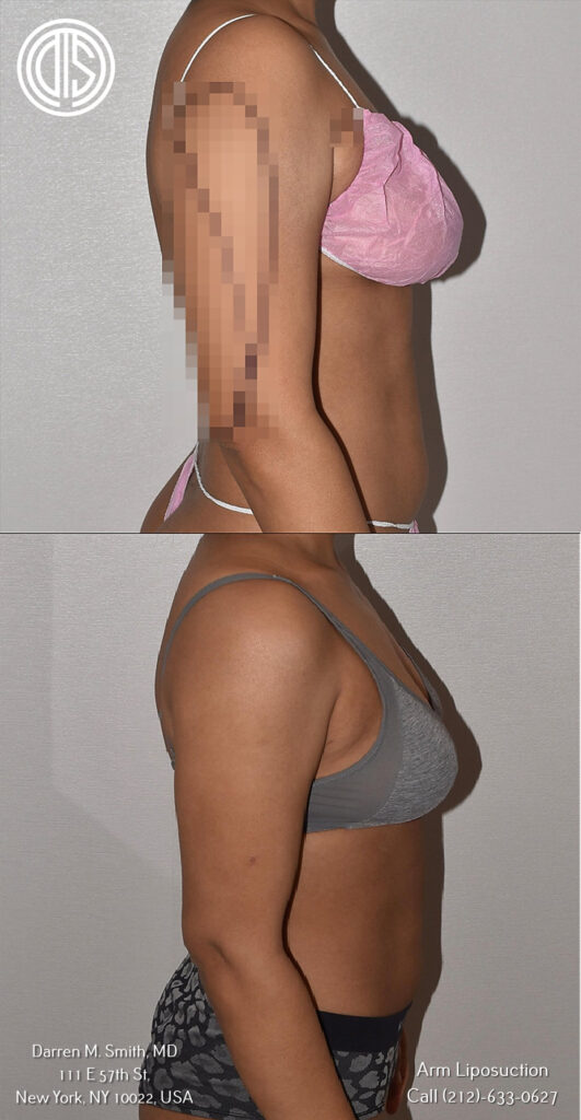 Arms & Shoulders Compression - SILIMED - Post liposuction recovery