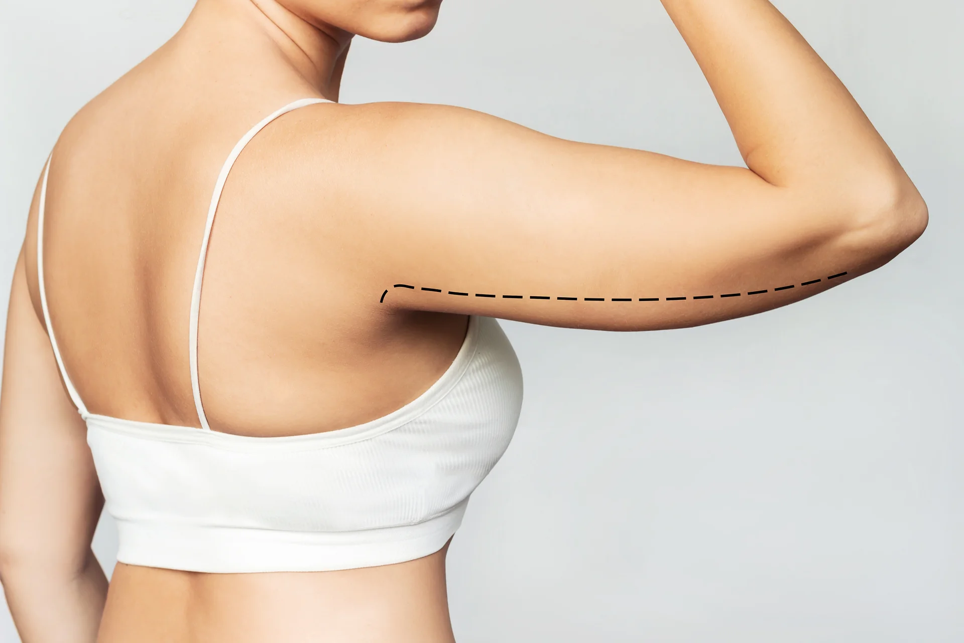 Sculpting Your Arms: The Ins and Outs of Arm Liposuction Recovery