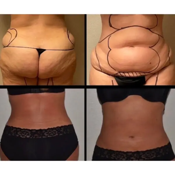 Laser Lipo 360 for Slim, Toned Abs & Love Handles Before & After