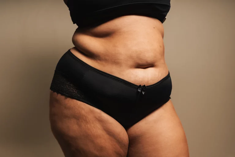 Person standing in black underwear and a black top, revealing the midsection and upper thigh area. The skin shows natural folds and texture, subtly highlighting the results of a recent Mommy Makeover.