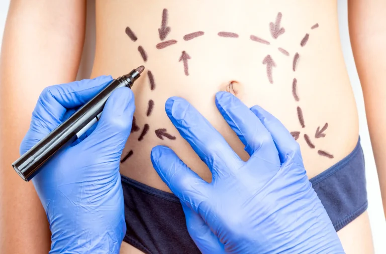 A person wearing blue gloves marks dotted lines and arrows with a black marker on another person's stomach, seemingly in preparation for an auto draft of the planned medical procedure.