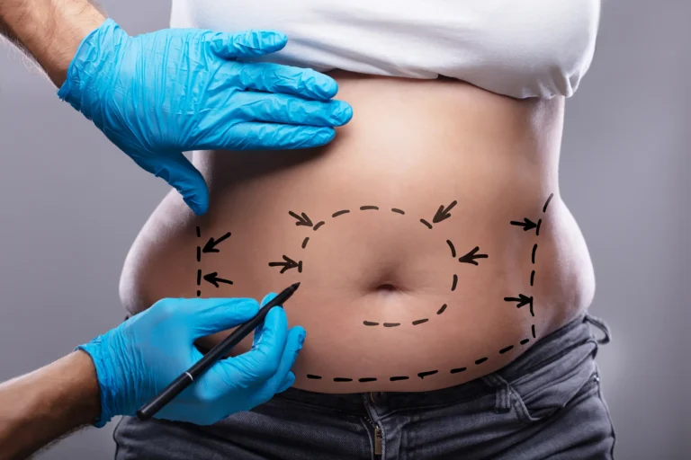A person is lying down with black markings on their abdomen for surgical planning. A professional with blue gloves is meticulously drawing on the person's stomach, ensuring every detail is ready for the procedure.