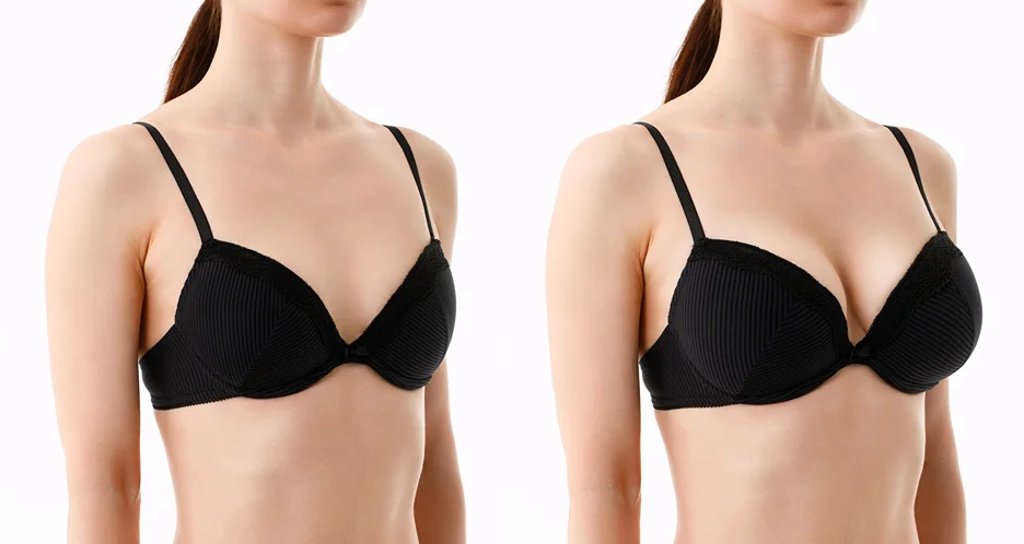 A Before and after Breast Augmentation Photos