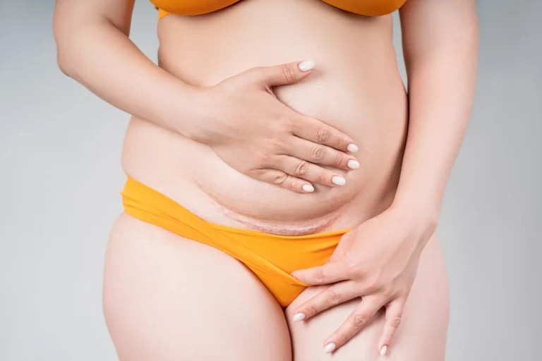 A person with light skin wearing orange underwear is holding their stomach with one hand and touching their thigh with the other, visible stretch marks and scars marking their abdomen like an auto draft of life’s battles.