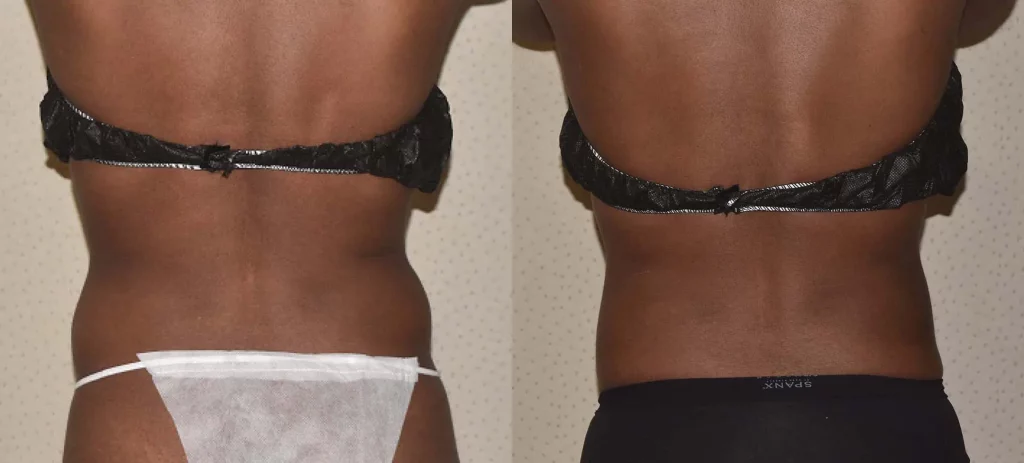 Two images show a comparison of a person's back, wearing different undergarments in each image. The left image shows the person in white underwear, the right image in black underwear, highlighting an area of paradoxial adipose on their skin.