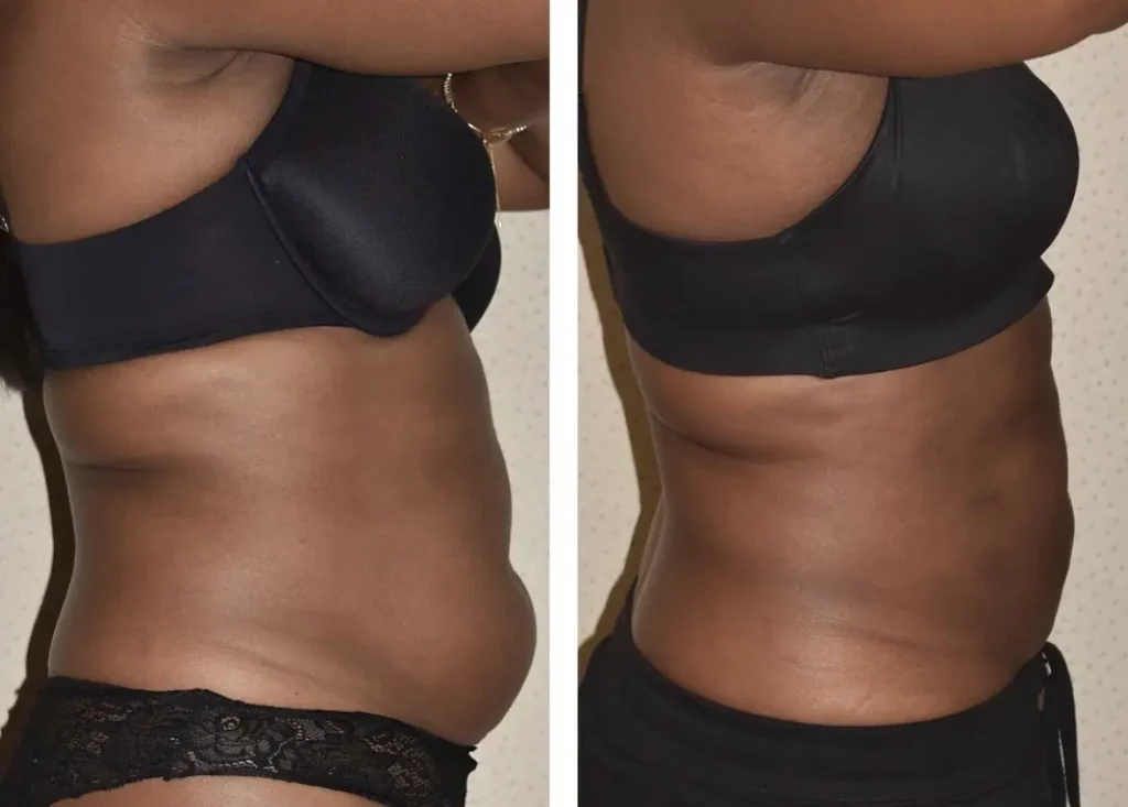 Two side-by-side images show a person’s torso wearing black undergarments, before and after achieving a noticeable reduction in abdominal fat. However, the transformation highlights concerns about Paradoxial Adipose Hyperplasia that can occur with some fat-reduction treatments.