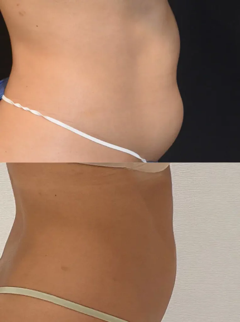 Two side-by-side images of a person's torso: the top image highlights adipose hyperplasia with a pronounced lower abdomen, while the bottom image showcases a flatter lower abdomen. Both images feature minimal clothing.