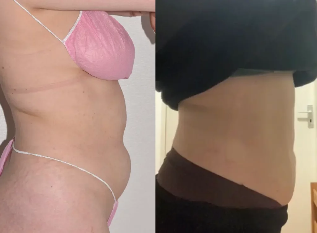 Side-by-side comparison of a person's midsection before (left) and after (right) revealing a significant reduction in abdominal size, highlighting the effective treatment despite concerns like Paradoxial Adipose Hyperplasia.