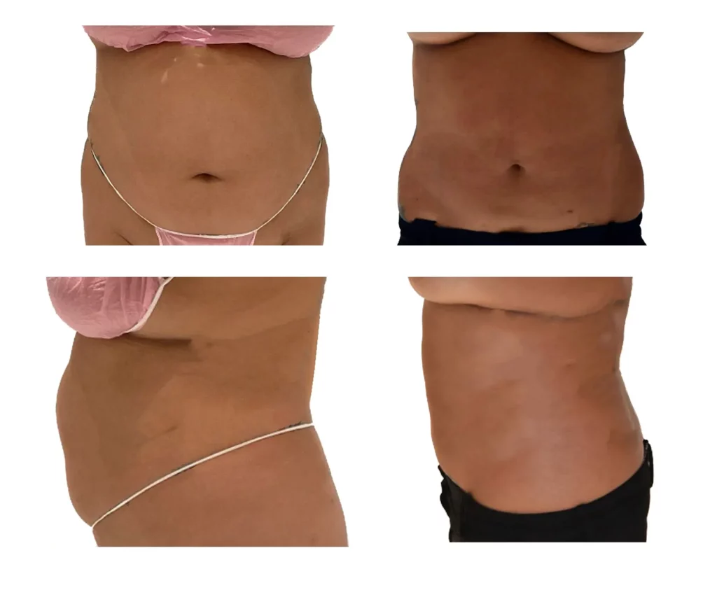 Before and after images showing the midsection of a person. The left column displays the pre-treatment condition while the right column shows the post-treatment results with a visibly slimmer abdomen, highlighting that Paradoxial Adipose Hyperplasia (PAH), a rare adverse effect of cryolipolysis, was not present.