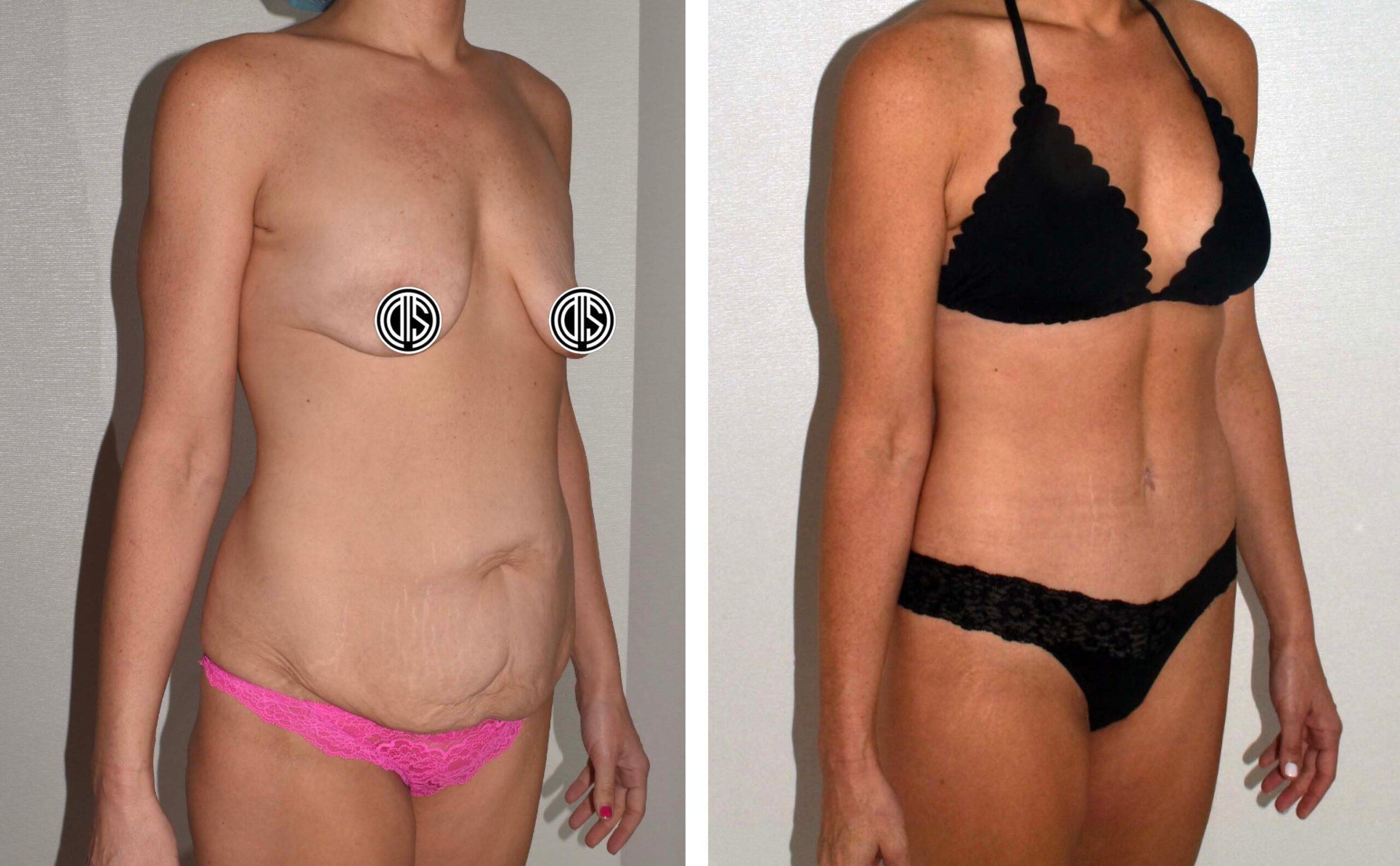 Side-by-side comparison of a person showing the torso and thighs before and after a Mommy Makeover, wearing lingerie in the first image and a bikini in the second.