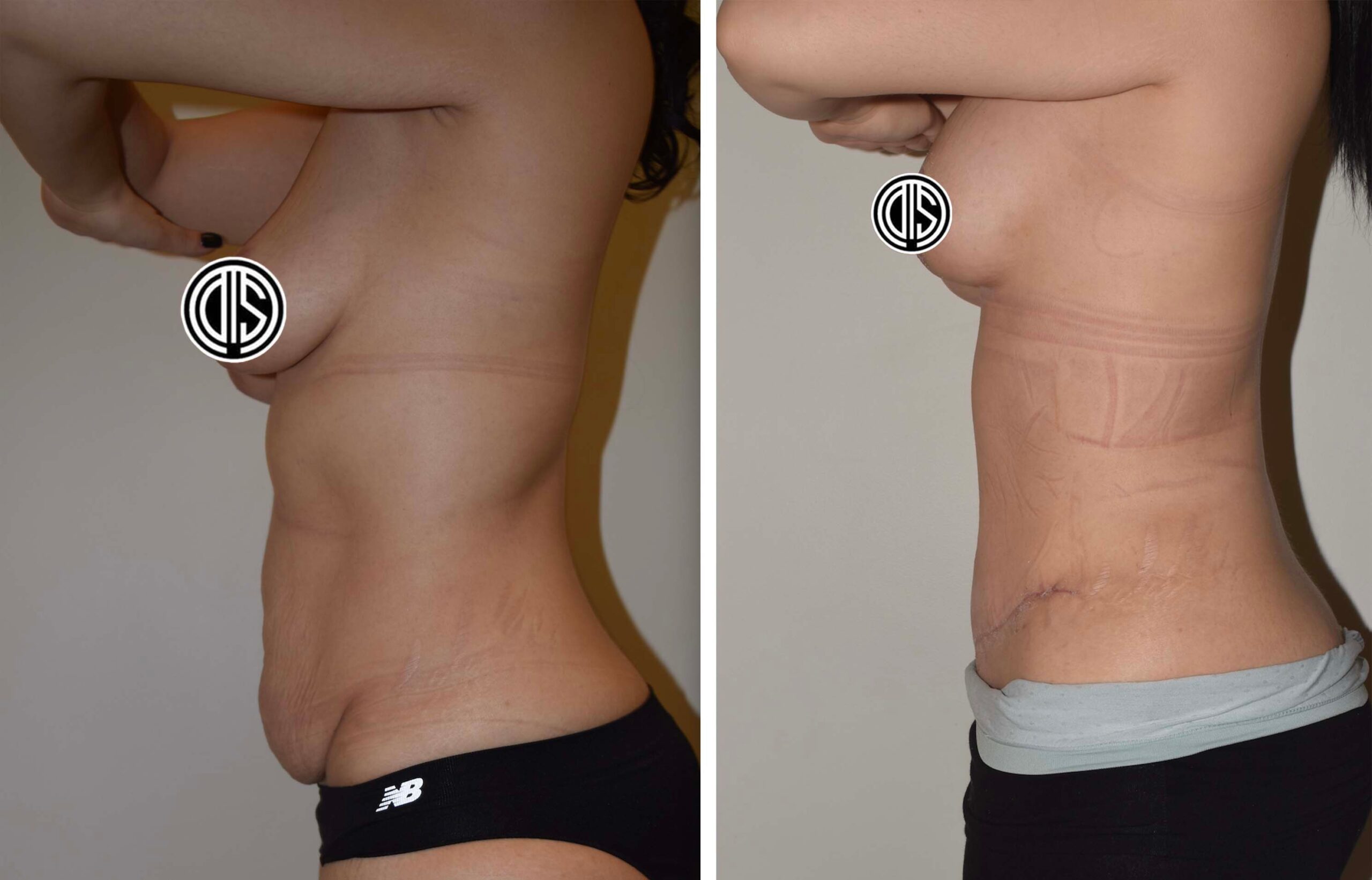 Side-by-side before and after photos of a person showing body changes, likely post-"Mommy Makeover" surgery. Both images depict the left profile from the waist up, with the after photo showing a flatter abdomen.