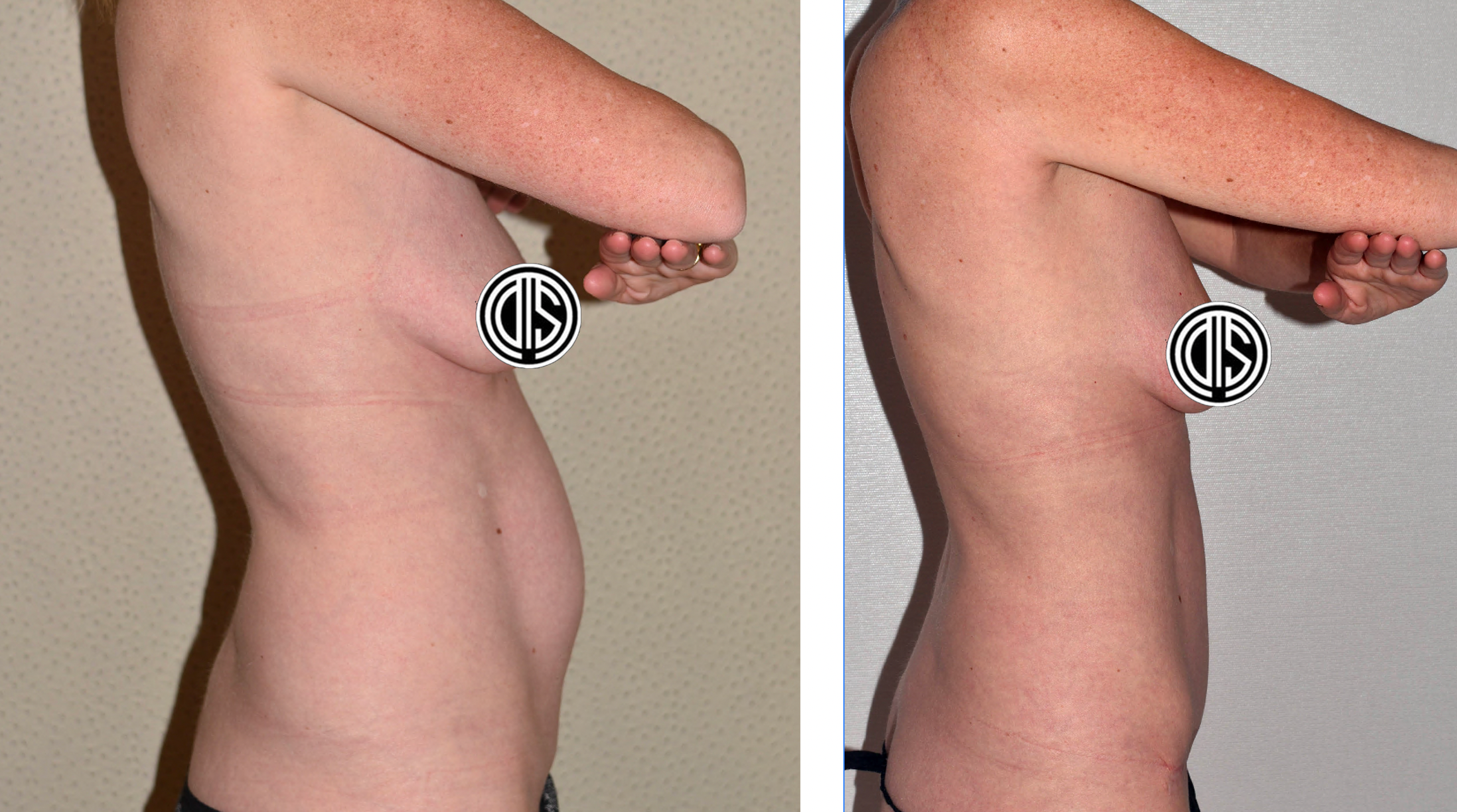 Two side-view photos comparing a person before (left) and after (right) a Mommy Makeover procedure. The before image shows a fuller profile, while the after image reveals a noticeably slimmer profile.