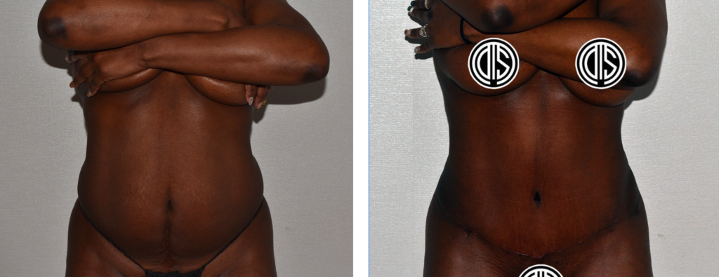 Two side-by-side images showing the torso of a person. Left image shows person before abdominoplasty; right image shows person after the cosmetic surgery, with improved skin tightness and visible surgical scar.