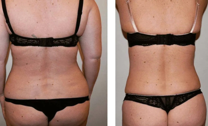 Comparison of a woman's back shows before (left) and after (right) body transformation, depicting significant weight loss and muscle toning while wearing black lingerie, highlighting the impressive results of her Mommy Makeover.