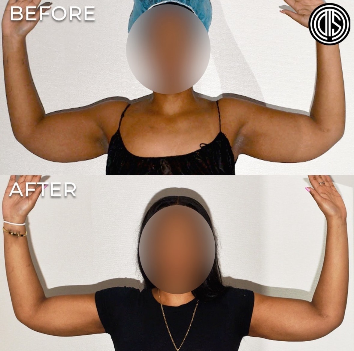 Comparison image showing two photos of a person with arms raised: the top labeled "Before" and the bottom "After," highlighting the transformation in their arms.