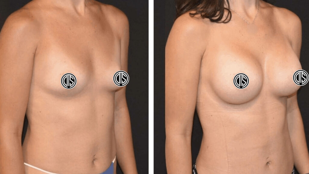 Side-by-side comparison of a woman's upper body before and after breast augmentation surgery with implants, clearly showing an increase in breast size.