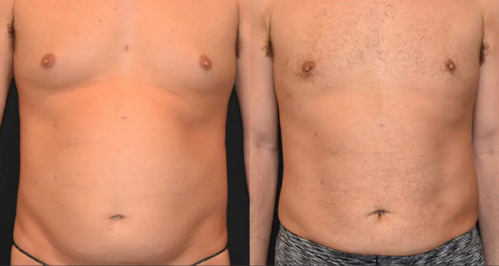 Before and after images of a man's torso highlight the remarkable changes in body size and shape, thanks to Airsculpt.