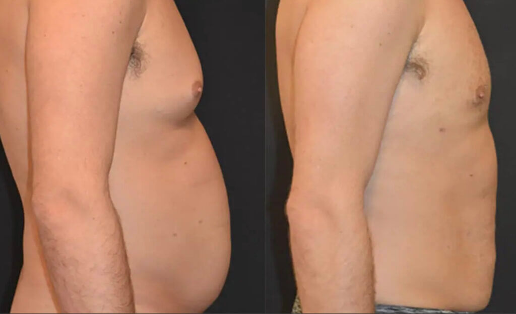 Side-by-side images reveal a man's torso transformation with AirSculpt, highlighting a noticeable reduction in abdominal size after weight loss.