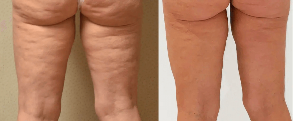 Comparison of two images showing the back of legs, with the left image displaying more pronounced cellulite and the right image showcasing smoother skin, possibly enhanced by Airsculpt.