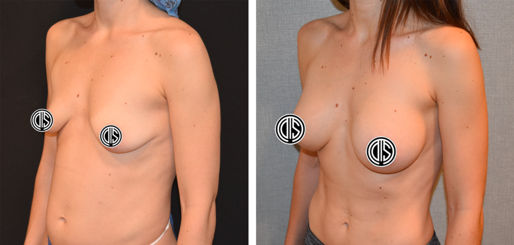 Two side-by-side images display a person's upper body from different angles before and after a body contouring procedure, with logos strategically placed for privacy.