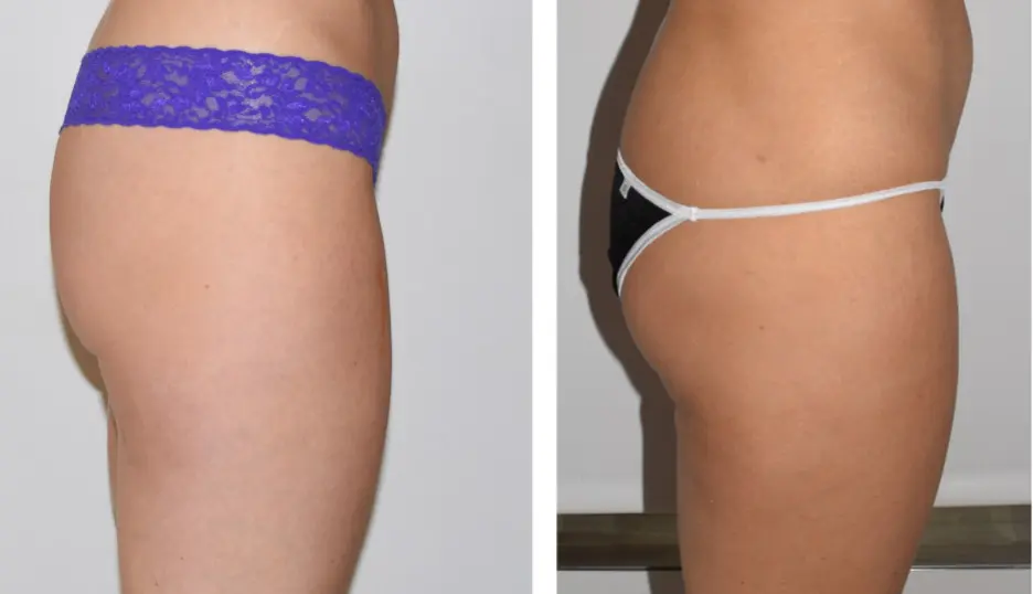 Side-by-side comparison of a person's hip area highlights different types of underwear: on the left, purple lace graces the hip, while the right showcases a black thong with a white band. The contrast elegantly accentuates the natural curves and hints at addressing banana rolls.