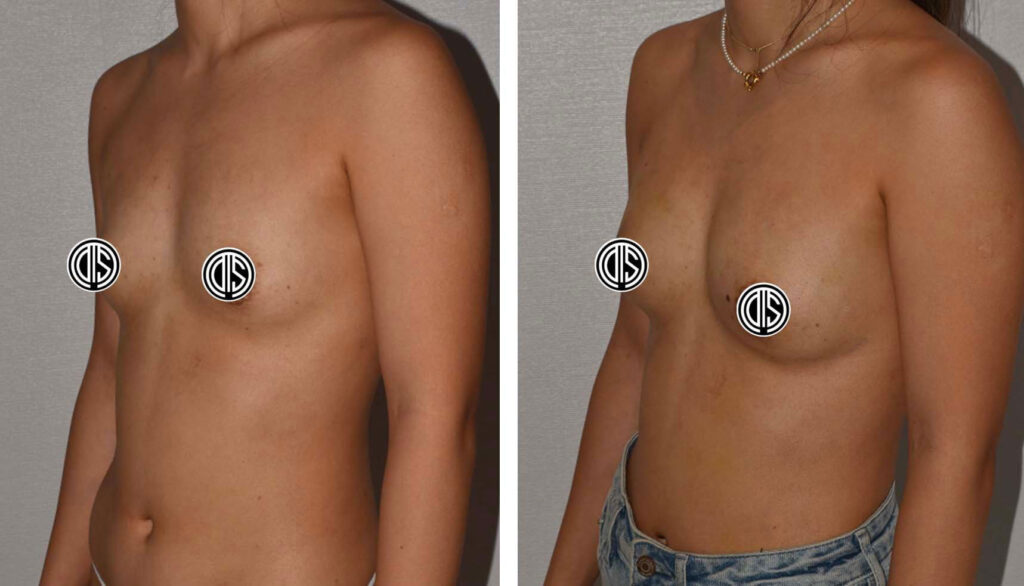 how much does a fat transfer breast augmentation cost