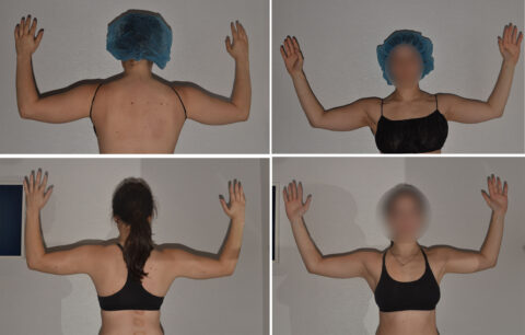 Four images capture two people, one wearing a blue cap, raising their arms against a neutral background. The photos emphasize their upper bodies and arm positioning, highlighting the grace and symmetry reminiscent of post-liposuction transformation.