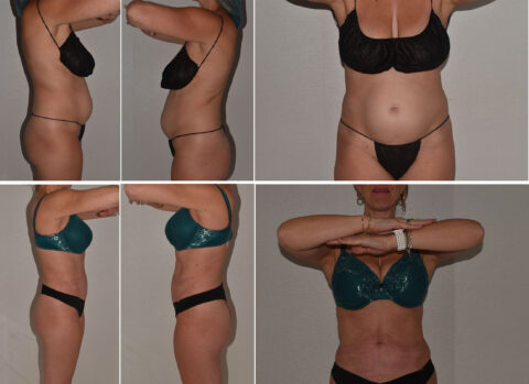 A woman in lingerie poses for before and after weight loss photos, showcasing her side and front profiles with visible changes, highlighting the transformation despite concerns of paradoxical adipose hyperplasia.