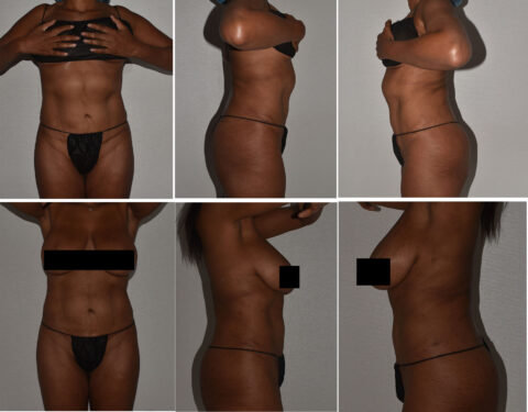 Before and after series of a person's torso from different angles, highlighting physical changes, including subtle signs of paradoxical adipose hyperplasia.