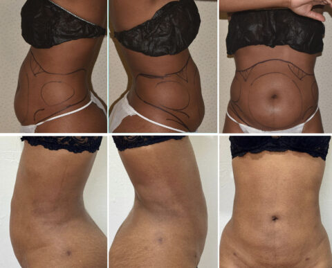 Six images display a woman's body featuring surgical markings and the apparent results of a cosmetic procedure on her waist and abdomen, while also highlighting signs of paradoxical adipose hyperplasia.