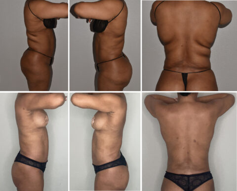 Side and back views of an individual wearing swimwear and underwear are displayed in six separate images, subtly highlighting the effects of Paradoxical Adipose Hyperplasia.