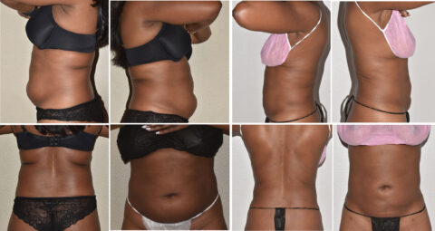 A collage of four before-and-after photos showcases a woman's torso in lingerie, highlighting her weight loss and body contouring results from various angles, achieved despite the challenges of paradoxical adipose hyperplasia.