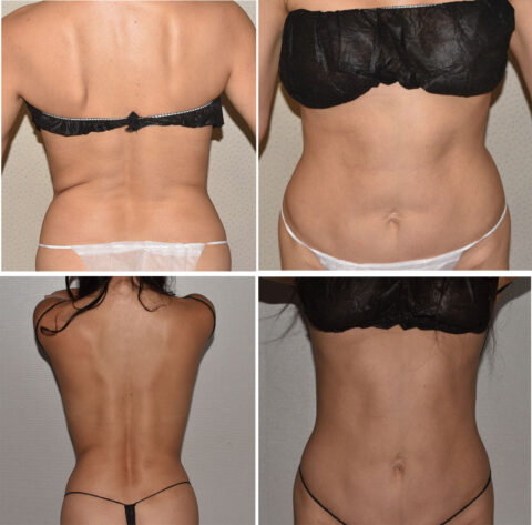 Before and after photos vividly showcase body transformation, emphasizing changes in the waist and back. The top images display the before state, while the bottom images reveal results post-process. Note: this transformation excludes cases like paradoxical adipose hyperplasia.