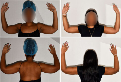 Four-panel image showing a person with arms raised, highlighting the results of cosmetic surgery. Top panels display arms extended sideways; bottom panels are from the back. Face is blurred in each, focusing on the transformation post-liposuction on the arms.